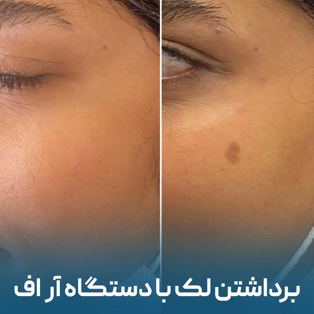 قبل و بعد درمان لک صورت با آر اف فرکشنال